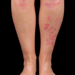 Auto-Immune Diseases